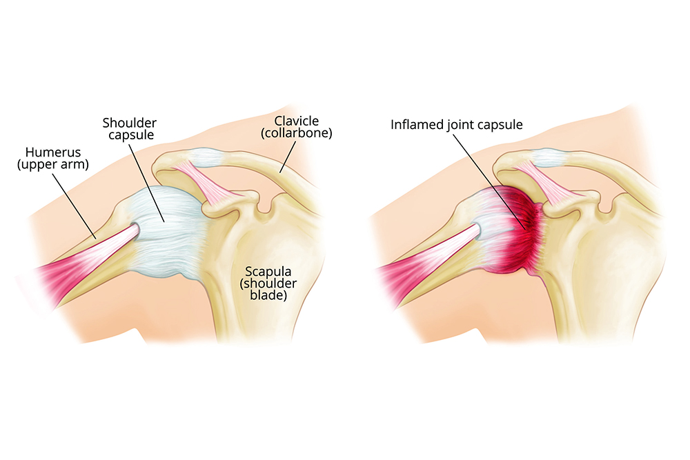 Frozen Shoulder and Physiotherapy