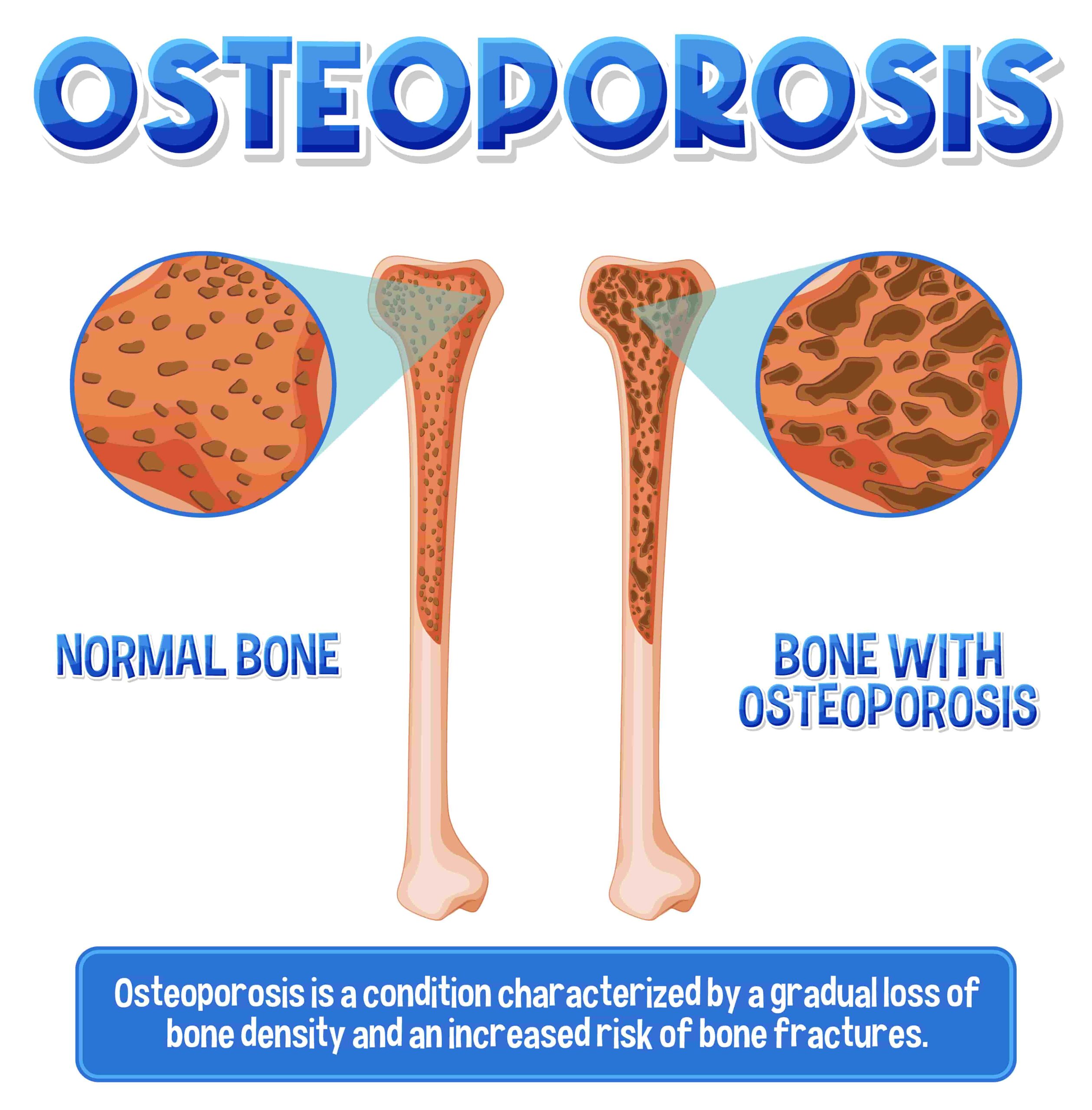 Best Treatment for Osteoporosis